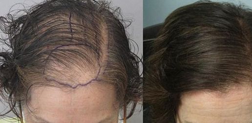 Before &After